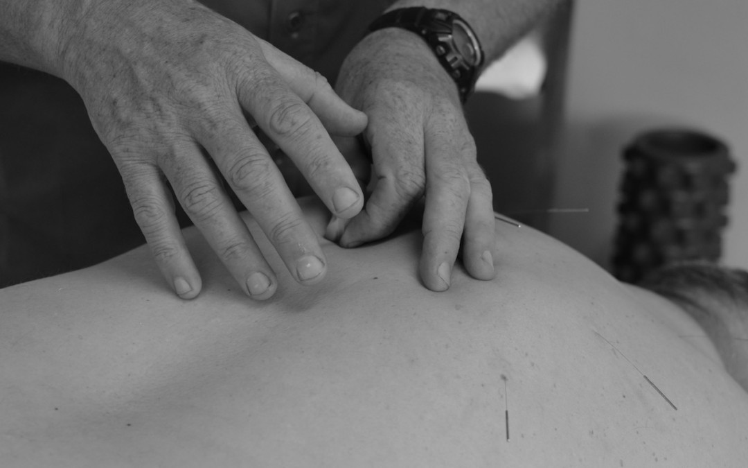 Informed Consent and Notes for Dry Needling