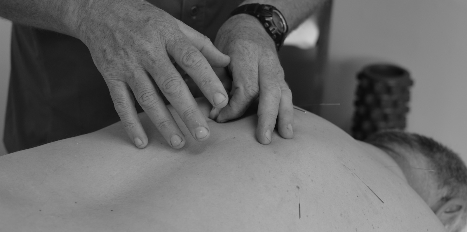 Informed Consent and Notes for Dry Needling