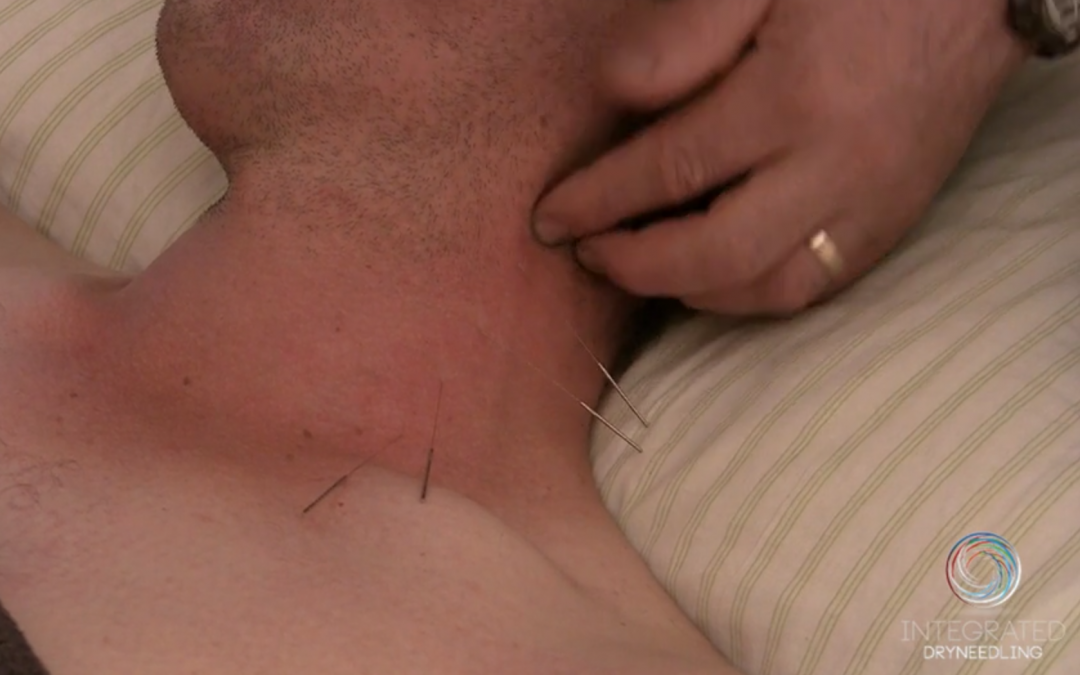 Integrated Dry Needling Techniques